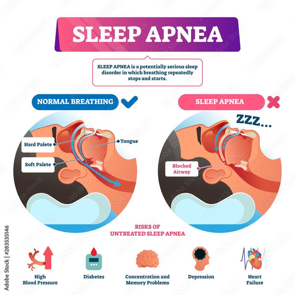 sleep apnea nexus letter template