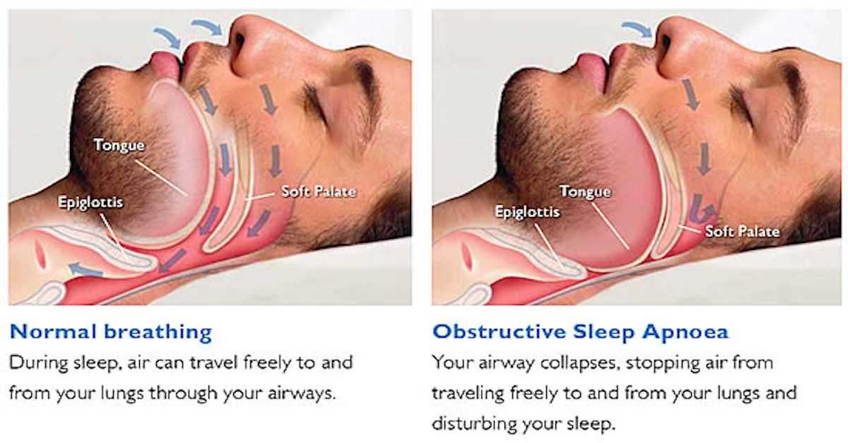 sleep apnea nexus letter template